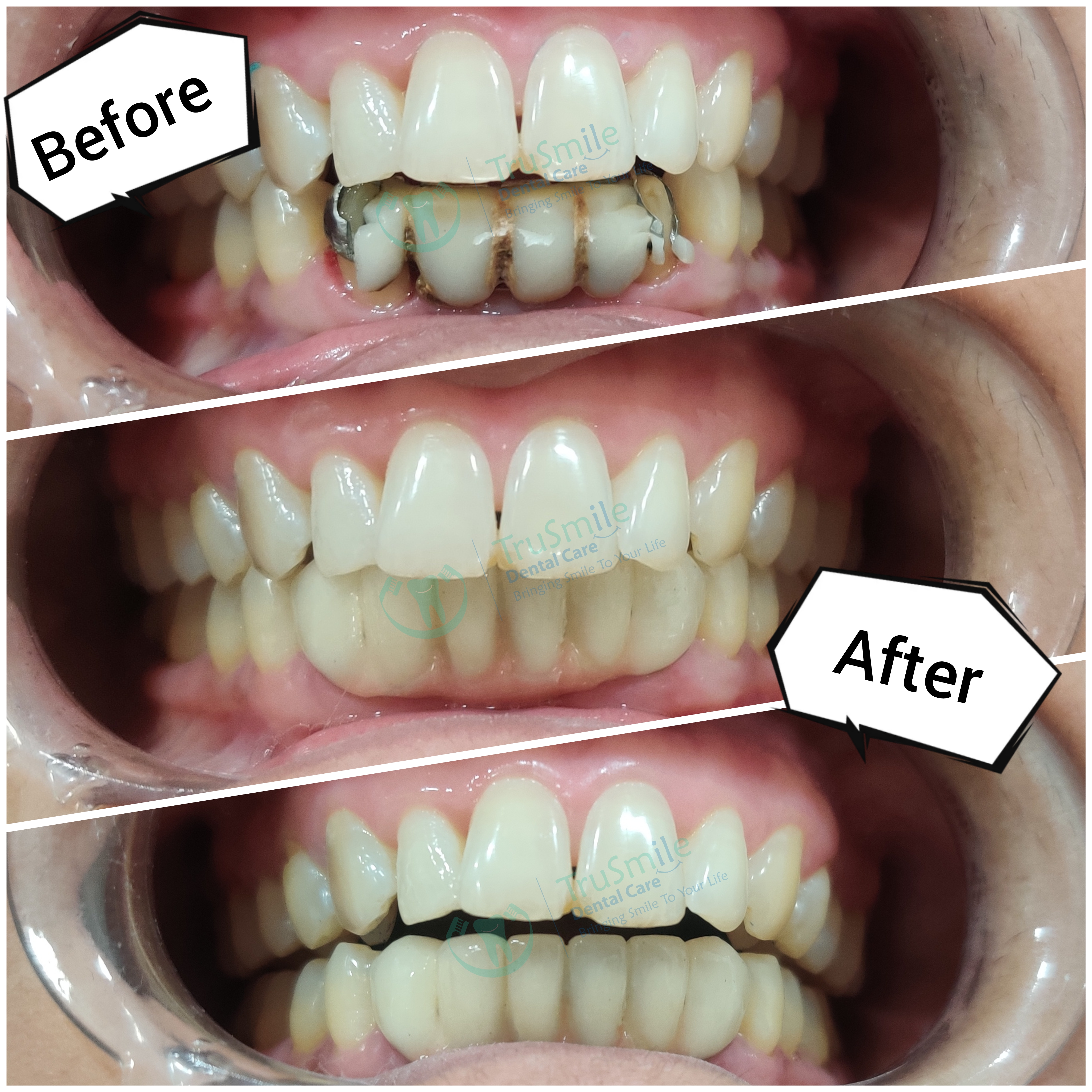 Zirconia 8